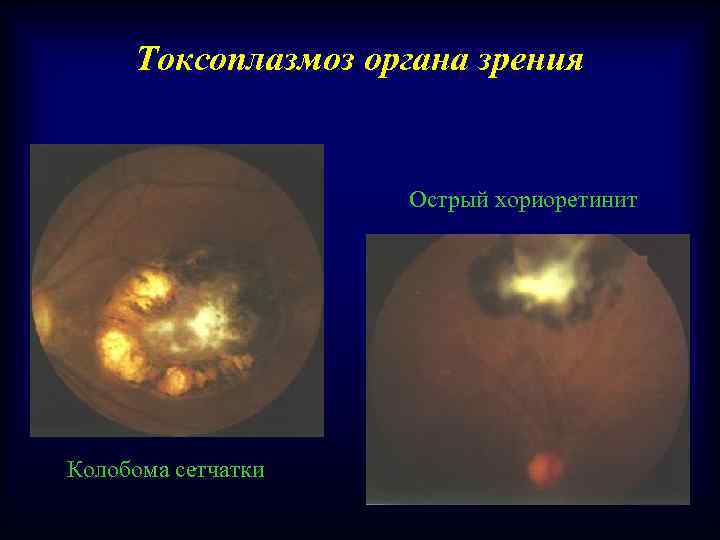 Токсоплазмоз органа зрения Острый хориоретинит Колобома сетчатки 