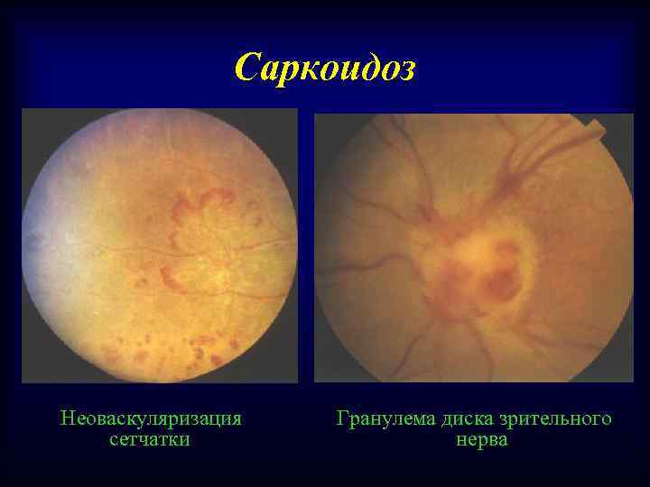 Саркоидоз Неоваскуляризация сетчатки Гранулема диска зрительного нерва 