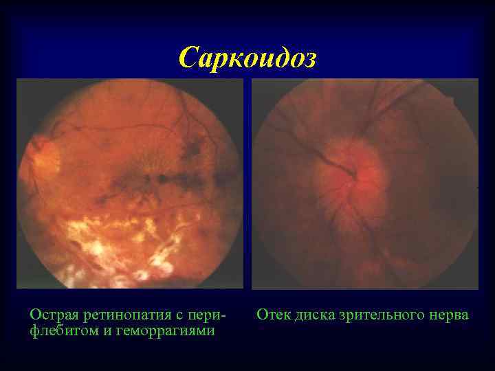Саркоидоз Острая ретинопатия с перифлебитом и геморрагиями Отек диска зрительного нерва 