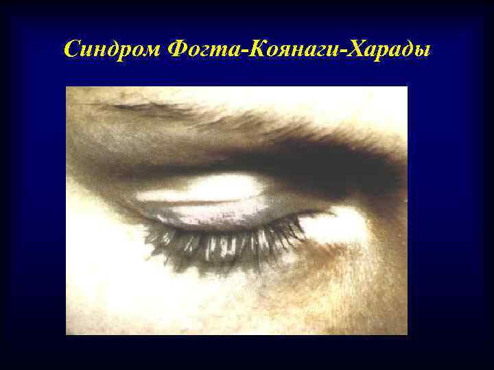 Синдром Фогта-Коянаги-Харады 