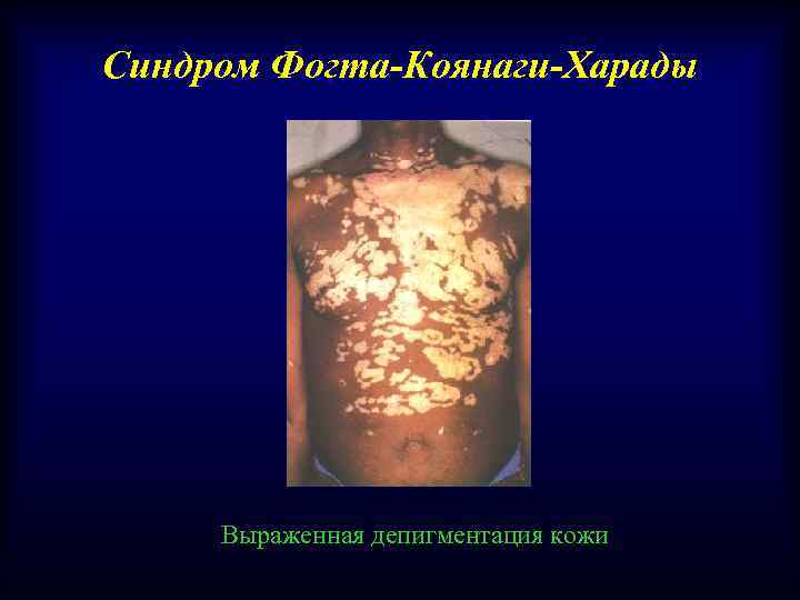Синдром Фогта-Коянаги-Харады Выраженная депигментация кожи 
