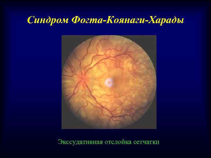 Синдром Фогта-Коянаги-Харады Экссудативная отслойка сетчатки 