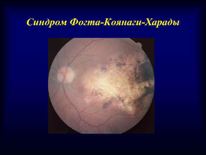 Синдром Фогта-Коянаги-Харады 