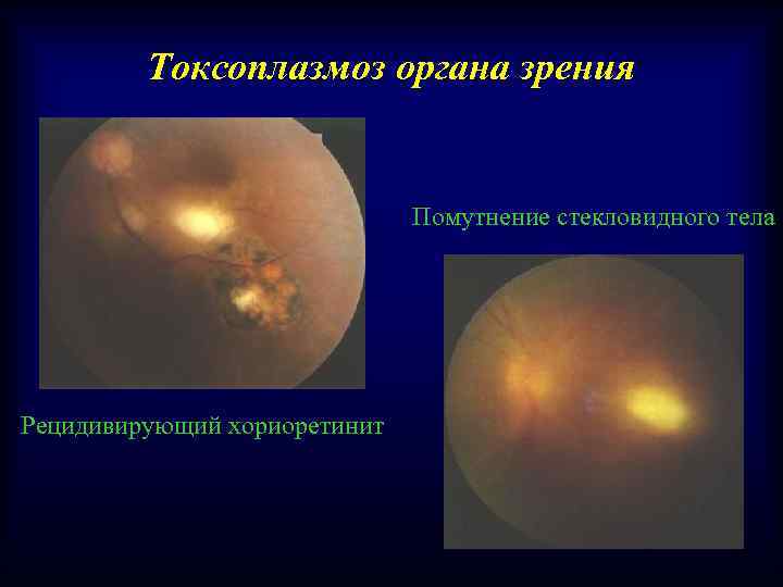 Токсоплазмоз органа зрения Помутнение стекловидного тела Рецидивирующий хориоретинит 