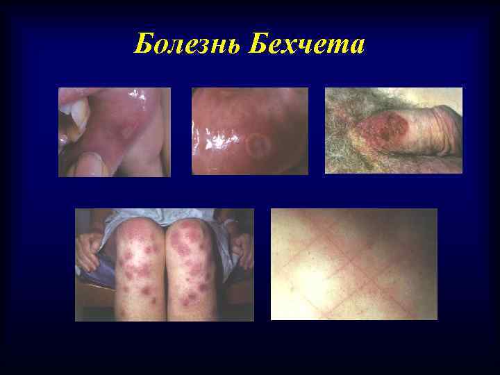 Болезнь Бехчета 