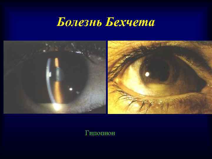 Болезнь Бехчета Гипопион 