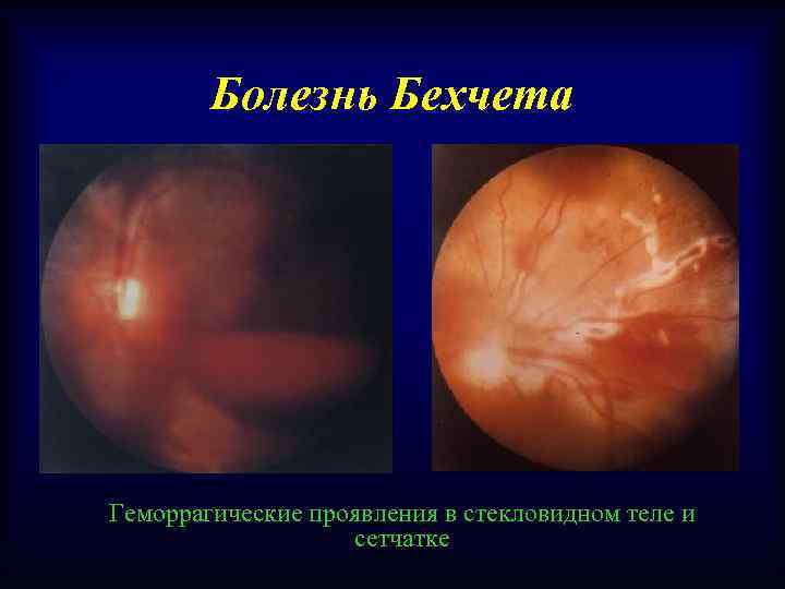 Болезнь Бехчета Геморрагические проявления в стекловидном теле и сетчатке 