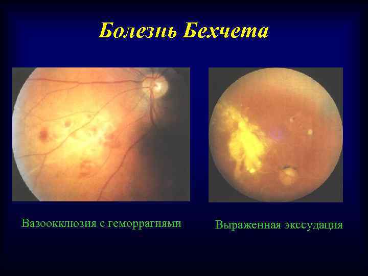 Болезнь Бехчета Вазоокклюзия с геморрагиями Выраженная экссудация 