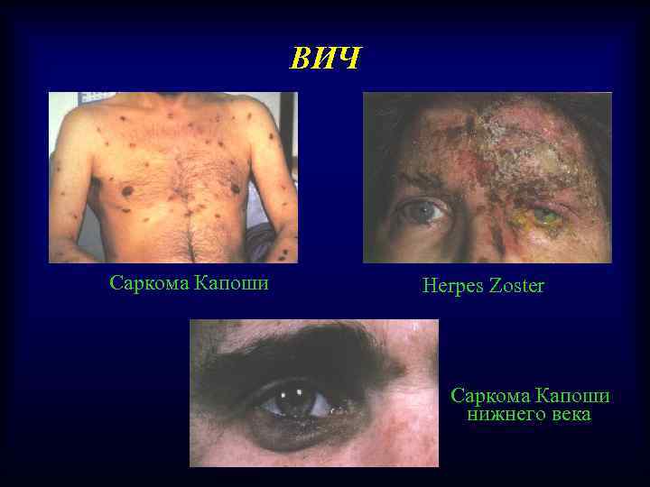 ВИЧ Саркома Капоши Herpes Zoster Саркома Капоши нижнего века 