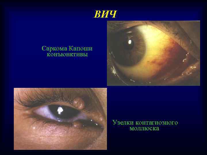 ВИЧ Саркома Капоши конъюнктивы Узелки контагиозного моллюска 