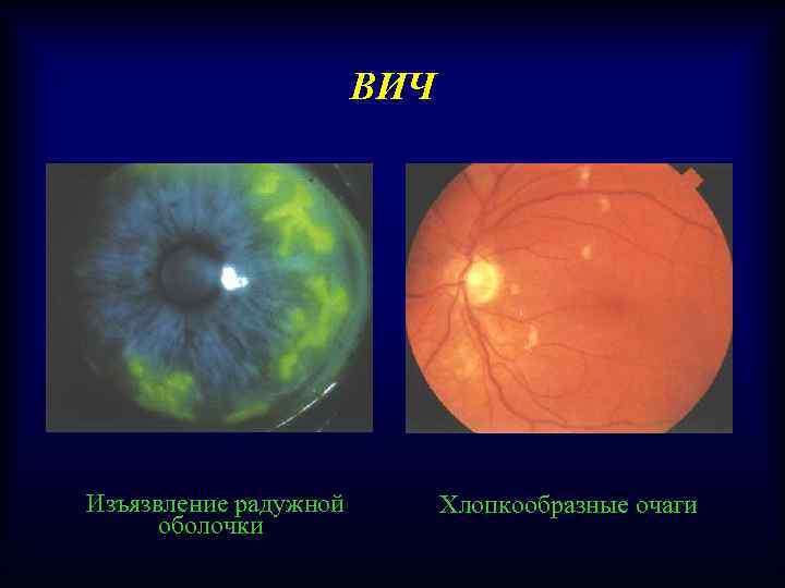 ВИЧ Изъязвление радужной оболочки Хлопкообразные очаги 