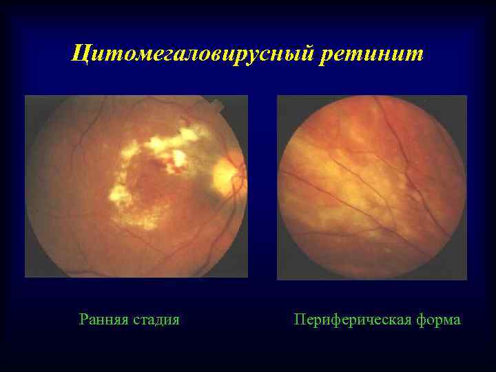 Цитомегаловирусный ретинит Ранняя стадия Периферическая форма 