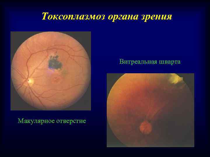 Токсоплазмоз органа зрения Витреальная шварта Макулярное отверстие 