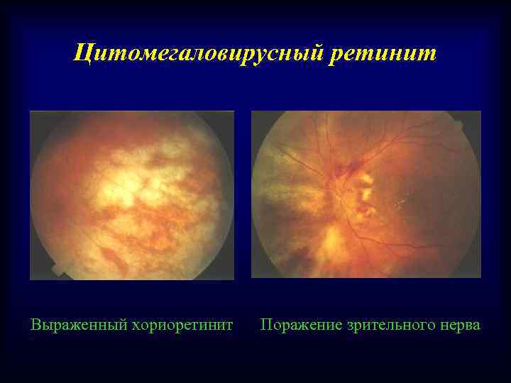 Цитомегаловирусный ретинит Выраженный хориоретинит Поражение зрительного нерва 
