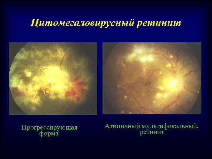 Цитомегаловирусный ретинит Прогрессирующая форма Атипичный мультифокальный. ретинит 