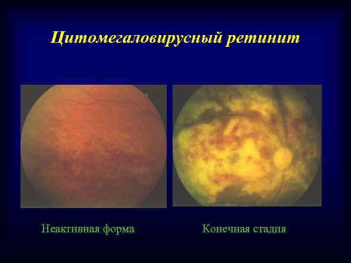 Цитомегаловирусный ретинит Неактивная форма Конечная стадия 