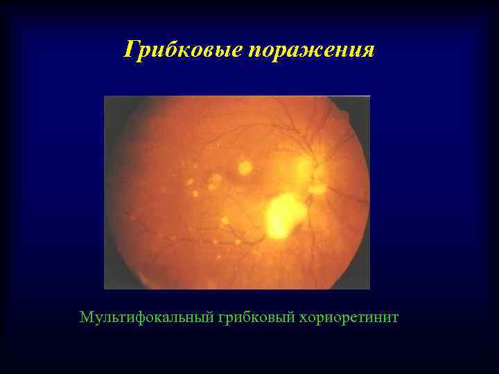 Грибковые поражения Мультифокальный грибковый хориоретинит 