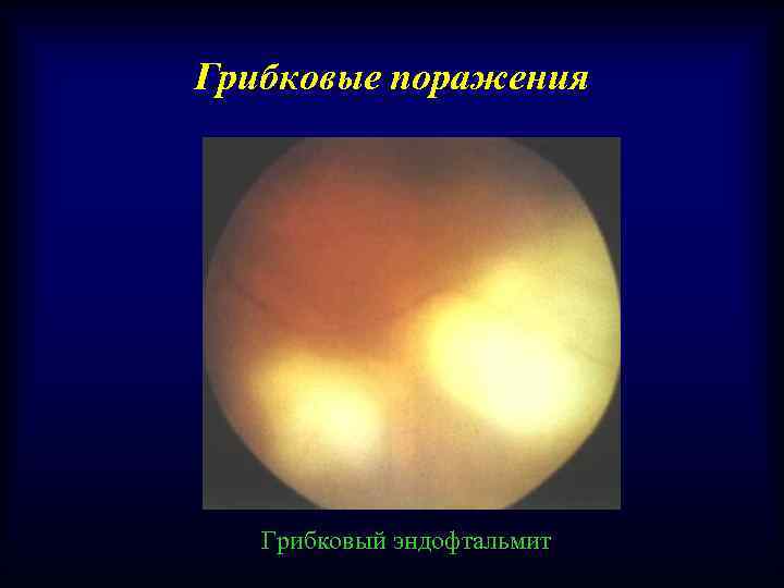 Грибковые поражения Грибковый эндофтальмит 