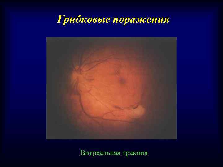 Грибковые поражения Витреальная тракция 