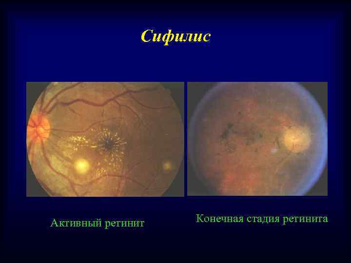 Сифилис Активный ретинит Конечная стадия ретинита 