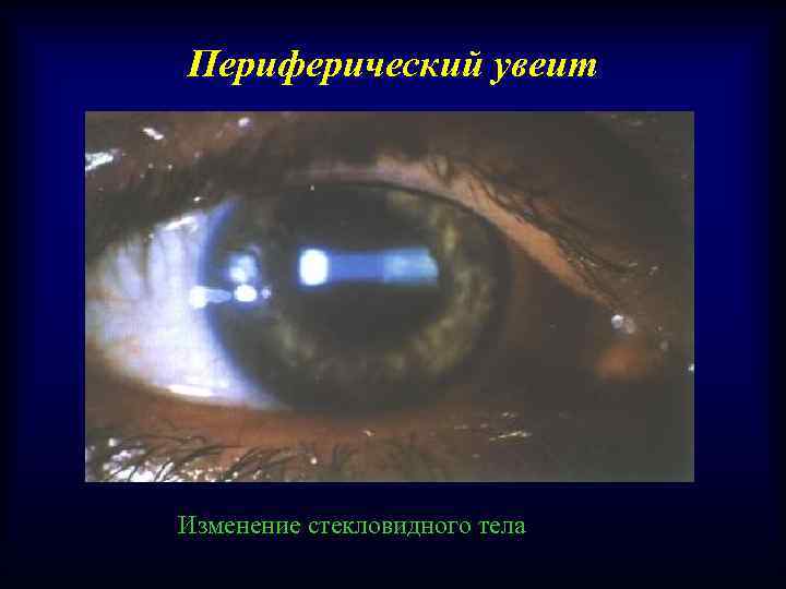 Периферический увеит Изменение стекловидного тела 