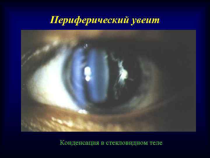 Периферический увеит Конденсация в стекловидном теле 