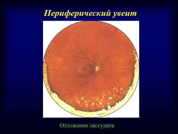 Периферический увеит Отложение экссудата 