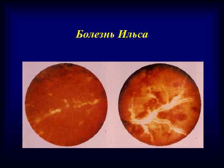 Болезнь Ильса 