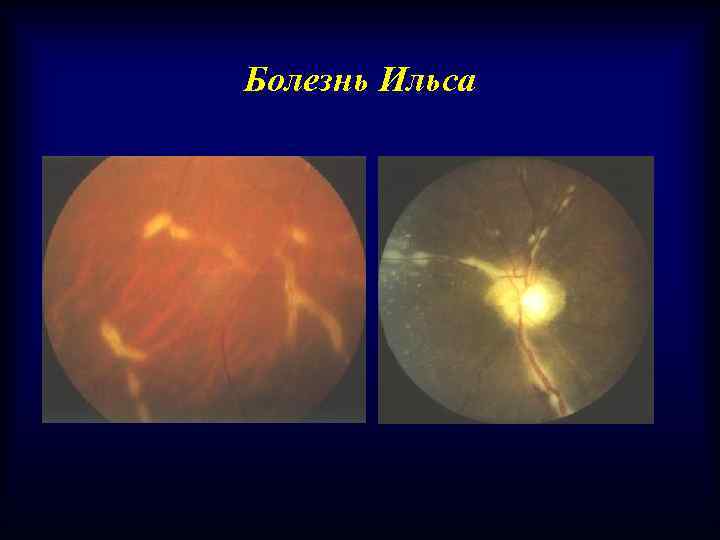 Болезнь Ильса 