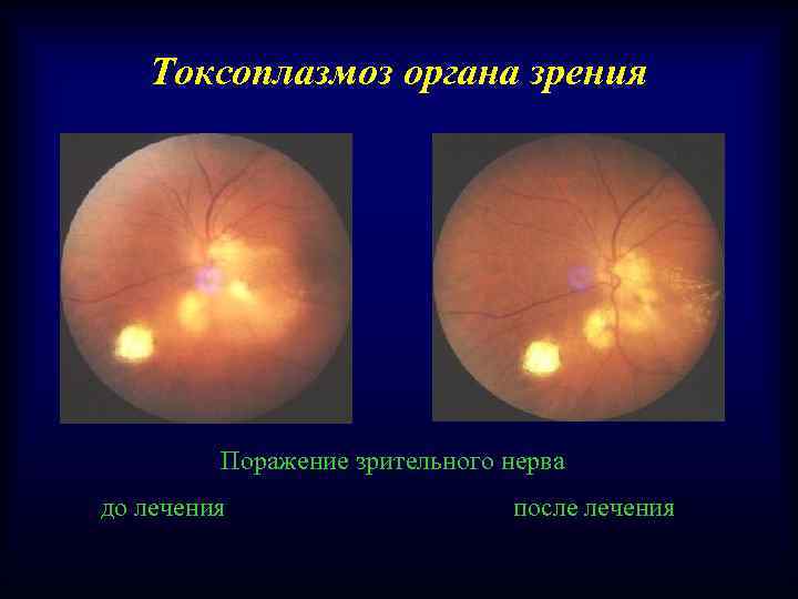 Токсоплазмоз органа зрения Поражение зрительного нерва до лечения после лечения 