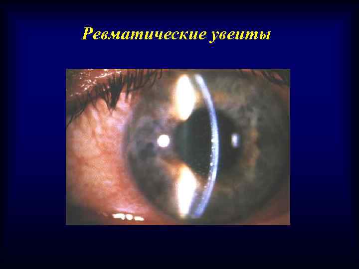 Ревматические увеиты 