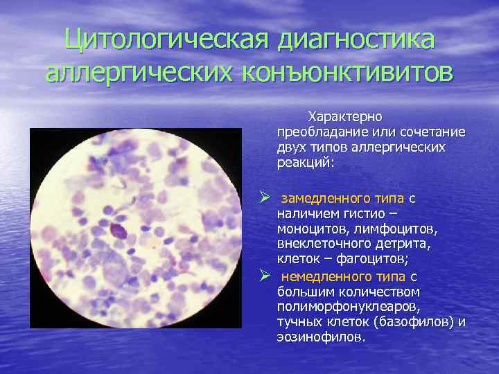 Цитологическая диагностика аллергических конъюнктивитов Характерно преобладание или сочетание двух типов аллергических реакций: Ø замедленного