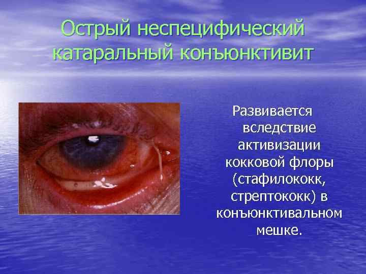 Острый неспецифический катаральный конъюнктивит Развивается вследствие активизации кокковой флоры (стафилококк, стрептококк) в конъюнктивальном мешке.