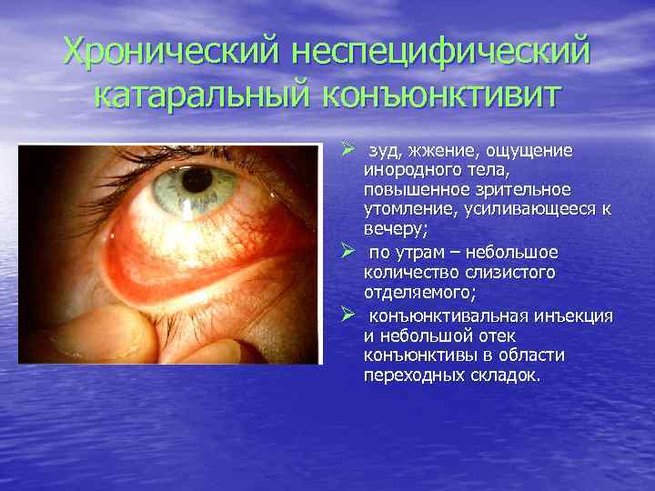 Хронический неспецифический катаральный конъюнктивит Ø зуд, жжение, ощущение Ø Ø инородного тела, повышенное зрительное