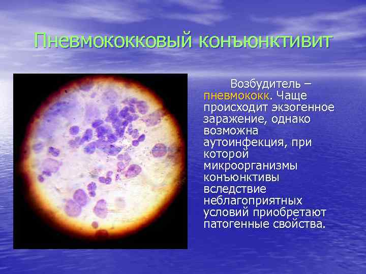 Пневмококковый конъюнктивит Возбудитель – пневмококк. Чаще происходит экзогенное заражение, однако возможна аутоинфекция, при которой