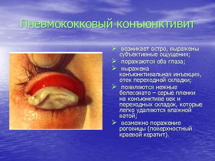 Пневмококковый конъюнктивит Ø возникает остро, выражены Ø Ø субъективные ощущения; поражаются оба глаза; выражена