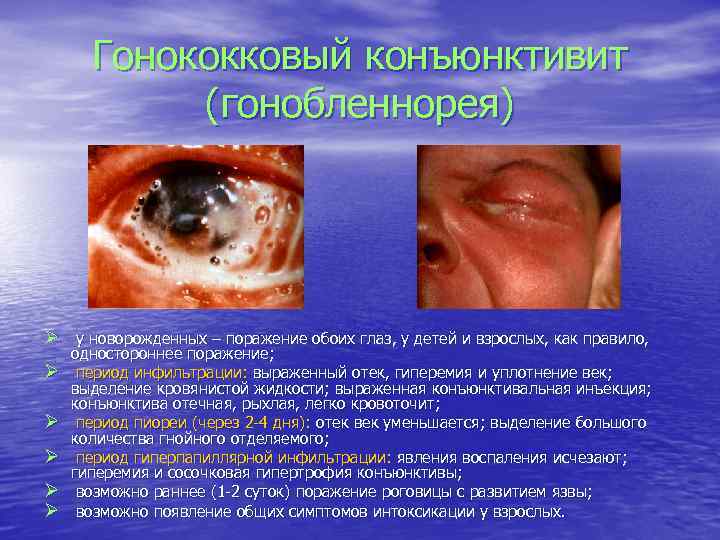 Гонококковый конъюнктивит (гонобленнорея) Ø у новорожденных – поражение обоих глаз, у детей и взрослых,