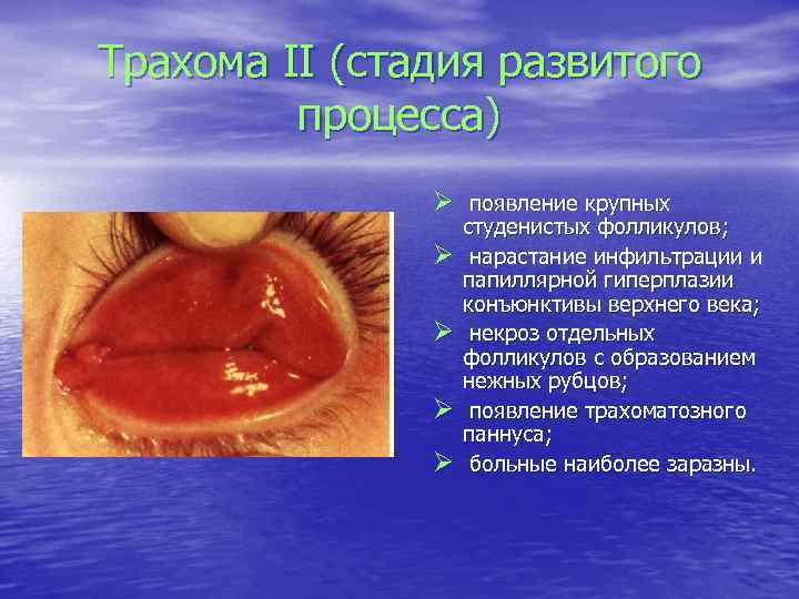 Трахома II (стадия развитого процесса) Ø появление крупных Ø Ø студенистых фолликулов; нарастание инфильтрации