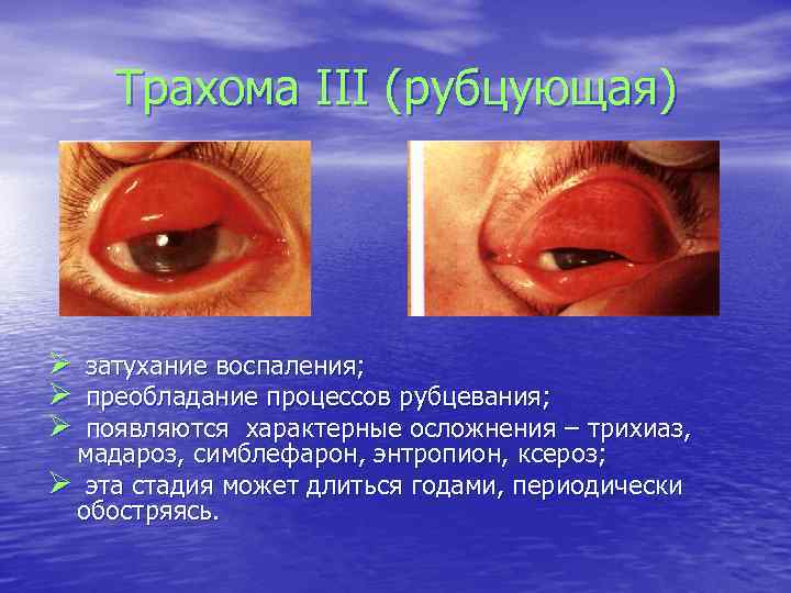 Трахома III (рубцующая) Ø затухание воспаления; Ø преобладание процессов рубцевания; Ø появляются характерные осложнения