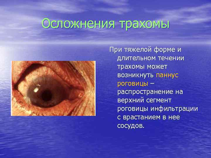 Осложнения трахомы При тяжелой форме и длительном течении трахомы может возникнуть паннус роговицы –