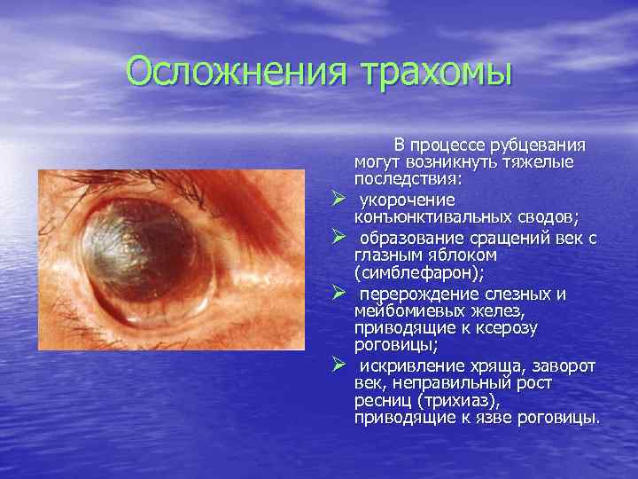 Осложнения трахомы Ø Ø В процессе рубцевания могут возникнуть тяжелые последствия: укорочение конъюнктивальных сводов;