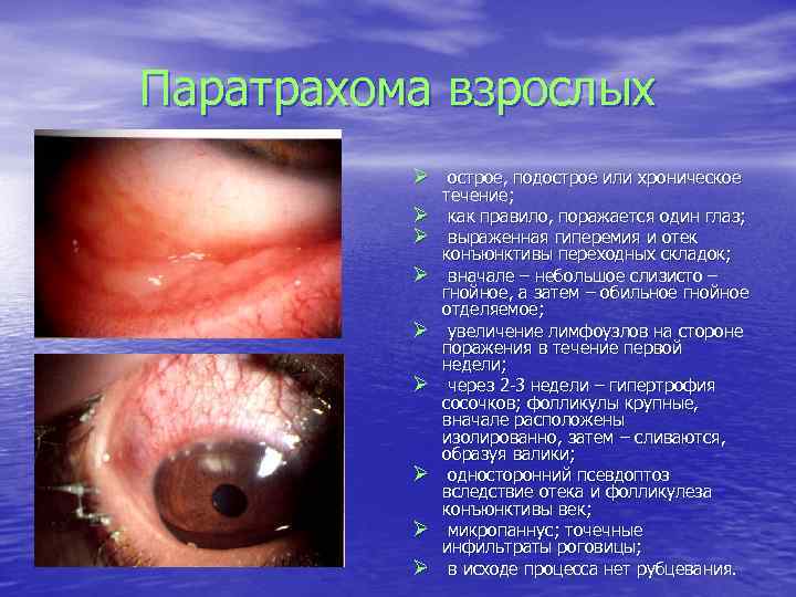 Паратрахома взрослых Ø острое, подострое или хроническое Ø Ø Ø Ø течение; как правило,