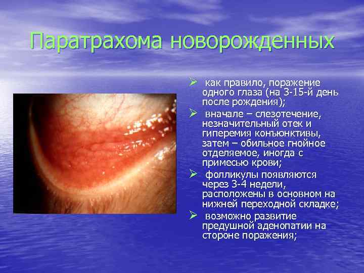 Паратрахома новорожденных Ø как правило, поражение Ø Ø Ø одного глаза (на 3 -15