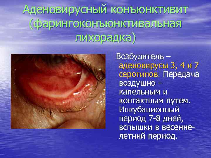 Аденовирусный конъюнктивит (фарингоконъюнктивальная лихорадка) Возбудитель – аденовирусы 3, 4 и 7 серотипов. Передача воздушно