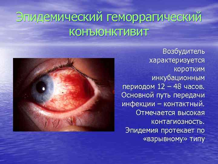 Эпидемический геморрагический конъюнктивит Возбудитель характеризуется коротким инкубационным периодом 12 – 48 часов. Основной путь