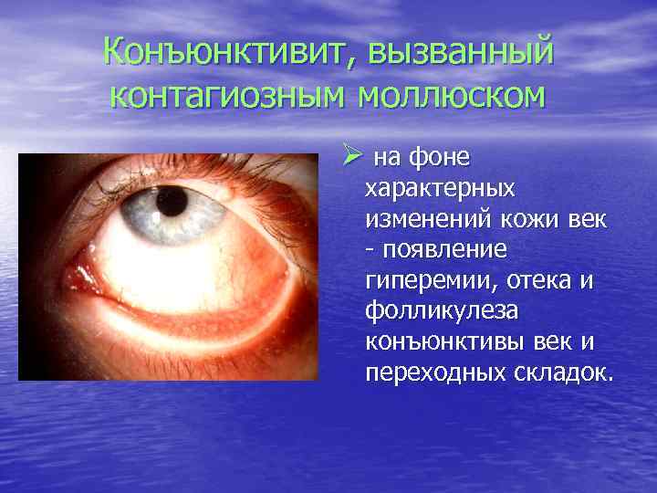 Конъюнктивит, вызванный контагиозным моллюском Ø на фоне характерных изменений кожи век - появление гиперемии,
