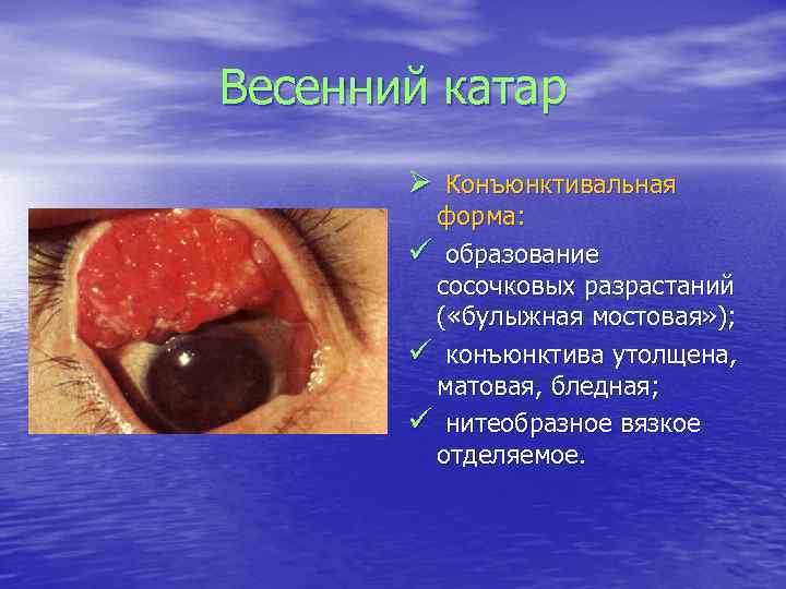 Весенний катар Ø Конъюнктивальная форма: ü образование сосочковых разрастаний ( «булыжная мостовая» ); ü