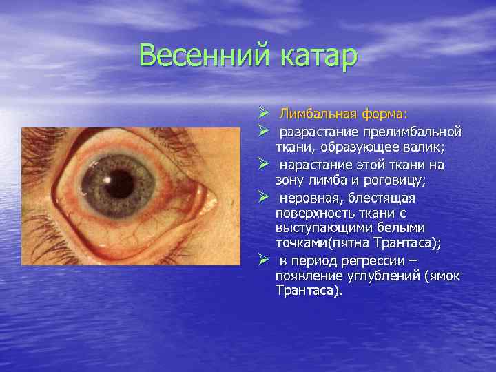 Весенний катар Ø Лимбальная форма: Ø разрастание прелимбальной Ø Ø Ø ткани, образующее валик;