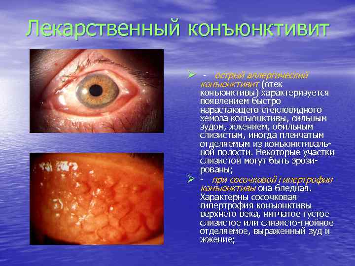 Лекарственный конъюнктивит Ø Ø - острый аллергический конъюнктивит (отек конъюнктивы) характеризуется появлением быстро нарастающего