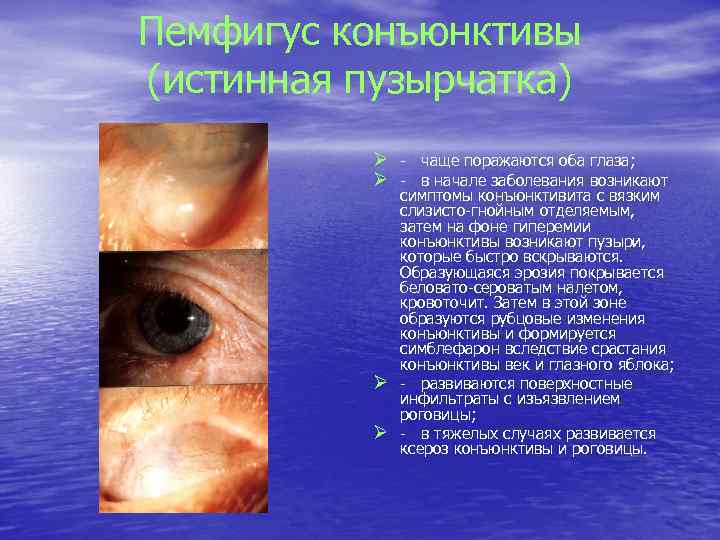 Пемфигус конъюнктивы (истинная пузырчатка) Ø - чаще поражаются оба глаза; Ø - в начале